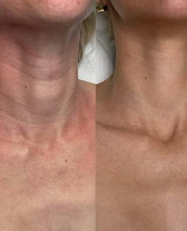 Antes e depois - pescoço e colo