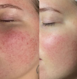 Antes e depois - textura e uniformidade facial