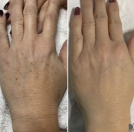 Antes e depois - mãos e manchas aparentes