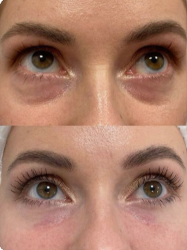 Antes e depois - área dos olhos