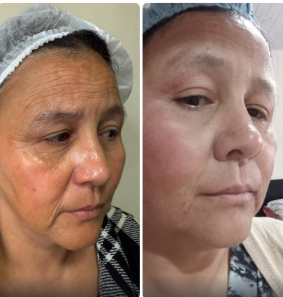 Antes e depois - rejuvenescimento facial
