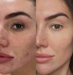 Antes e depois - textura e uniformidade