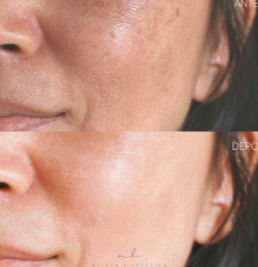 Antes e depois - qualidade da pele