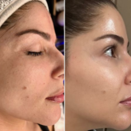 Antes e depois - luminosidade e uniformidade