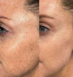 Antes e depois - manchas e tom da pele